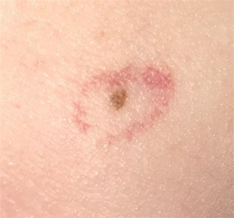 red ring around mole and itchy